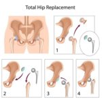 Images of a hip replacement