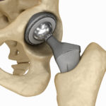 hip-implant-pic